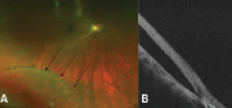 Imaging in Retinoschisis - Retina Today